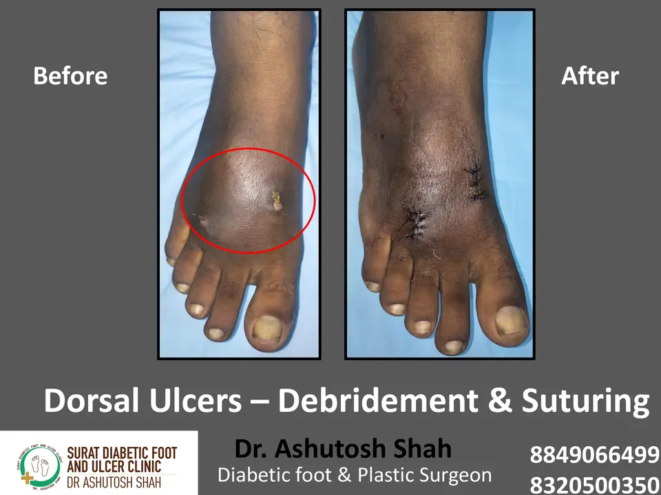 Diabetic Foot  PPT 3 checked by sir.pptx-61.webp